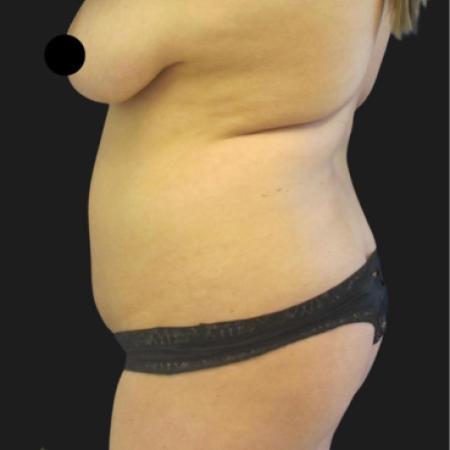 Before image 3 Case #116651 - 23 year-old patient | Liposuction