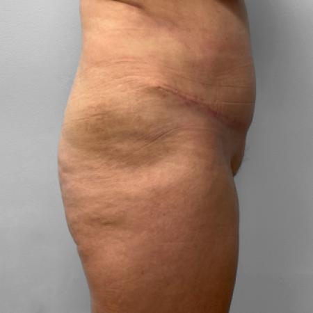 After image 3 Case #116866 - Tummy Tuck & Lipo