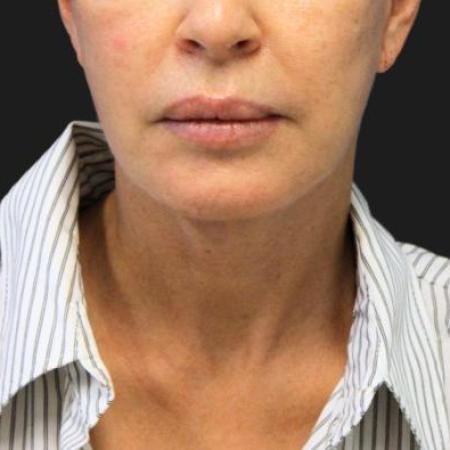 After image 1 Case #116241 - 55 year old patient | Facial Rejuvenation