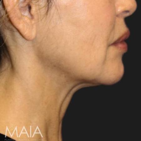 Before image 3 Case #116241 - 55 year old patient | Facial Rejuvenation