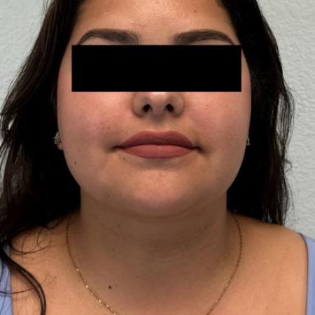 After image 1 Case #116096 - Submental neck liposuction