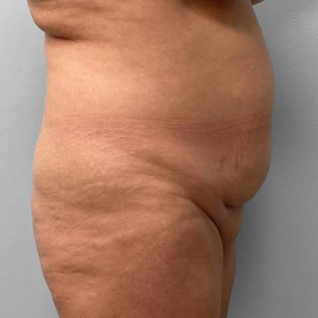 Before image 3 Case #116866 - Tummy Tuck & Lipo