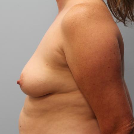 Before Case #116856 - Breast Augmentation and Mastopexy