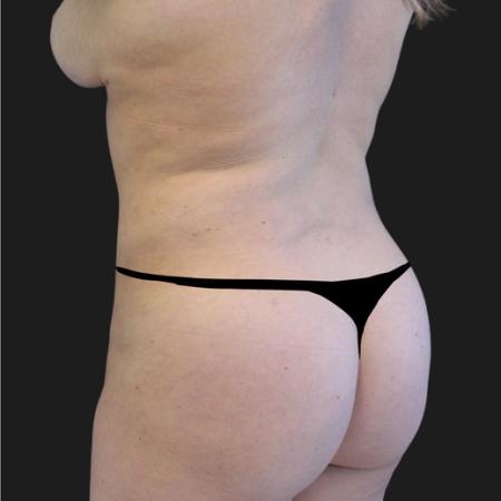 After image 4 Case #116651 - 23 year-old patient | Liposuction