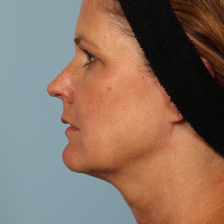 Before image 3 Case #116611 - Facelift and Eyelid Rejuvenation