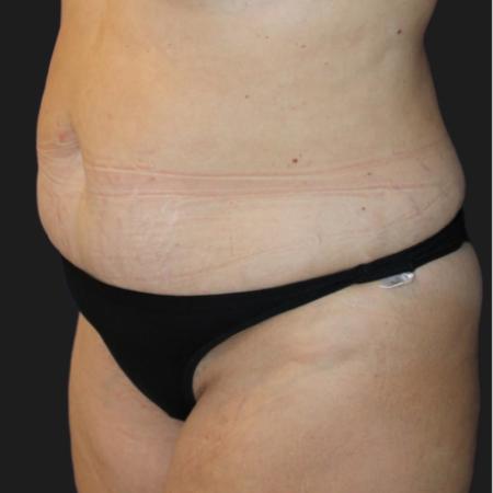 Before image 4 Case #116601 - 53 year-old patient | Mommy Makeover