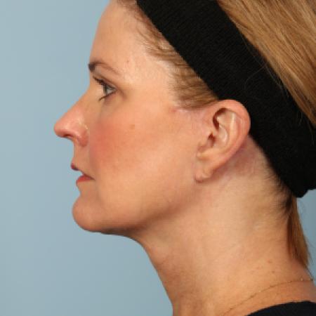 After image 3 Case #116501 - Facelift and Eyelid Contouring