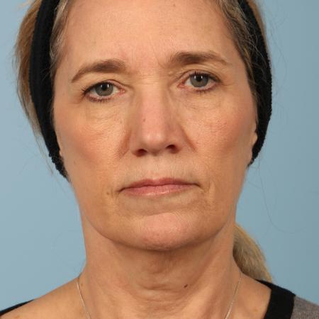 Before image 1 Case #116606 - Facelift with Fat Transfer