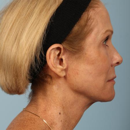 After image 3 Case #116596 - Total Facial Rejuvenation