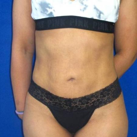 After image 1 Case #116661 - 38 year-old patient | Liposuction