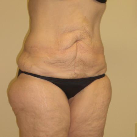 Before image 2 Case #116766 - Body Contouring after Weight Loss