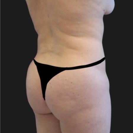 After image 2 Case #116651 - 23 year-old patient | Liposuction