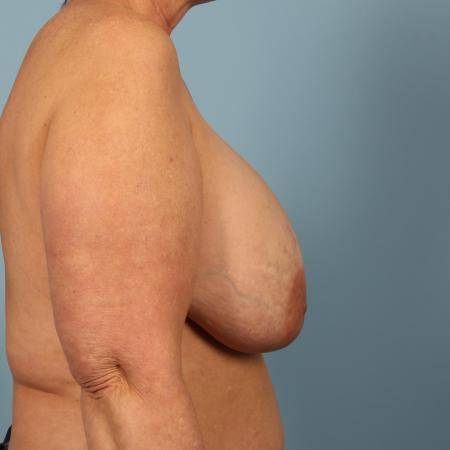 Before image 3 Case #116521 - Breast Implant Removal and Breast Lift