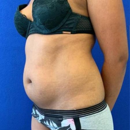 Before image 2 Case #116661 - 38 year-old patient | Liposuction