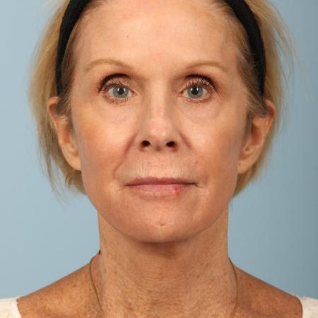 After image 1 Case #116596 - Total Facial Rejuvenation