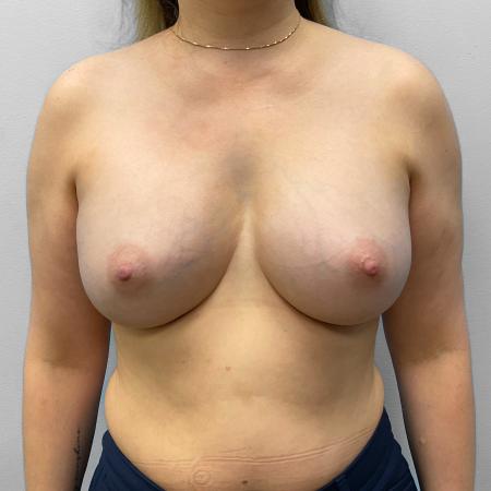 Before image 1 Case #116861 - Breast Augmentation