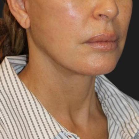 After image 2 Case #116241 - 55 year old patient | Facial Rejuvenation