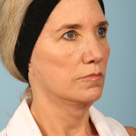 After image 2 Case #116606 - Facelift with Fat Transfer