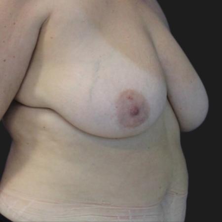 Before image 2 Case #116601 - 53 year-old patient | Mommy Makeover