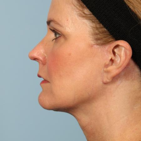 After image 3 Case #116611 - Facelift and Eyelid Rejuvenation