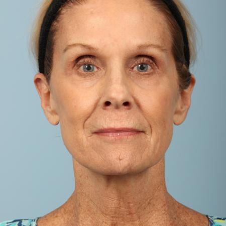 Before image 1 Case #116596 - Total Facial Rejuvenation