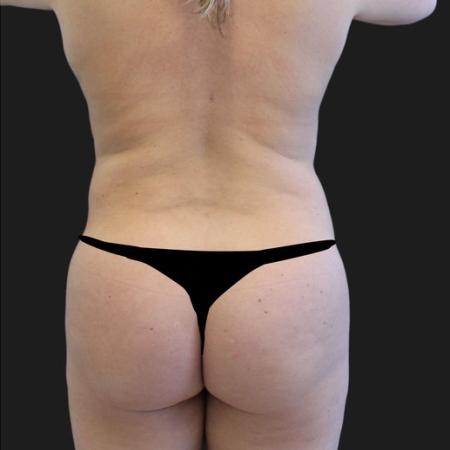 After image 5 Case #116651 - 23 year-old patient | Liposuction