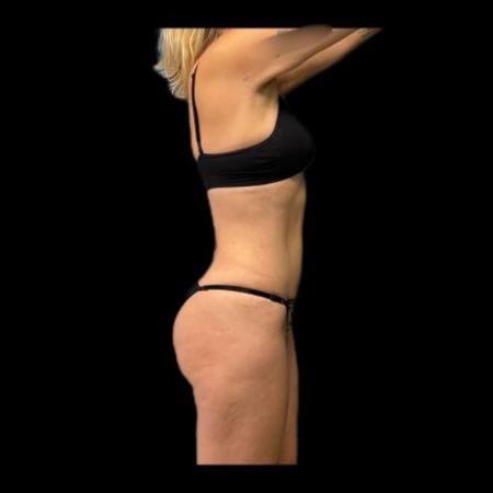 After image 6 Case #116076 - R.A.F.T LipoAbdominoplasty and LipoEsculture 