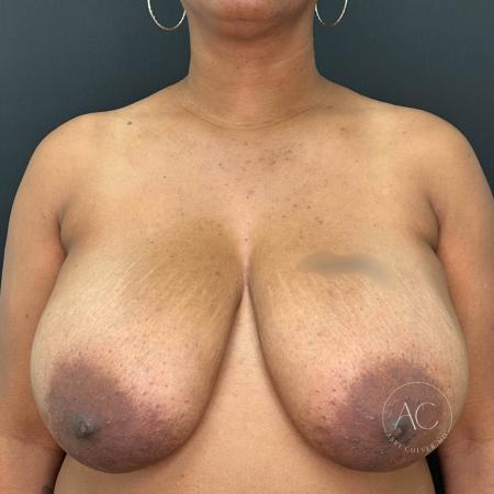 Before image 1 Case #116406 - Breast Reduction 