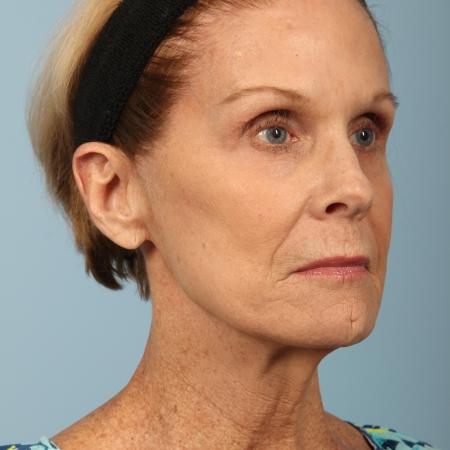 Before image 2 Case #116596 - Total Facial Rejuvenation