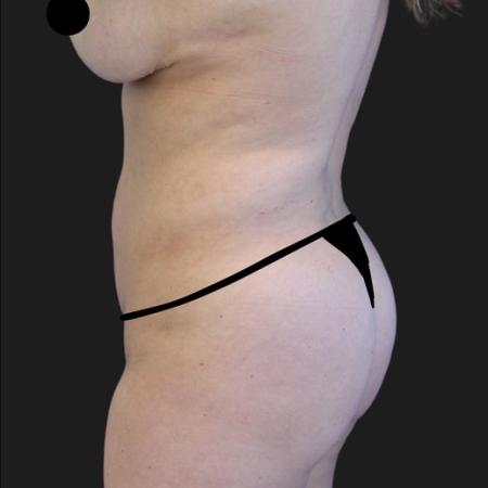 After image 3 Case #116651 - 23 year-old patient | Liposuction