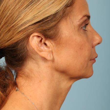 Before image 3 Case #116586 - Facelift, Necklift