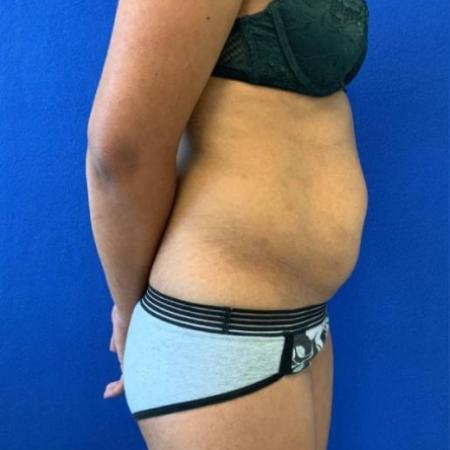 Before image 3 Case #116661 - 38 year-old patient | Liposuction