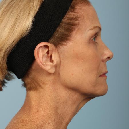 Before image 3 Case #116596 - Total Facial Rejuvenation