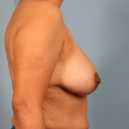 After image 3 Case #116516 - Breast Implant Removal and Augmentation with Fat