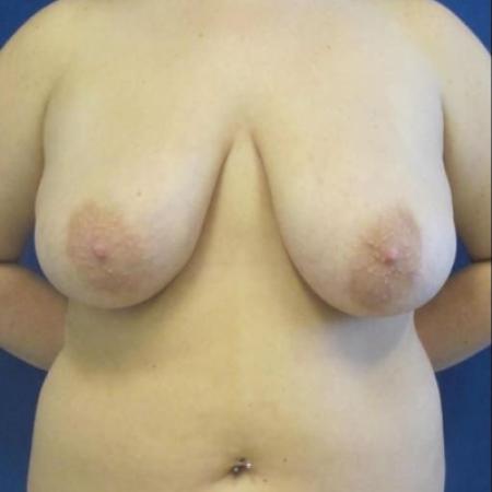 Before image 1 Case #116806 - 22 year-old patient | Breast Reduction