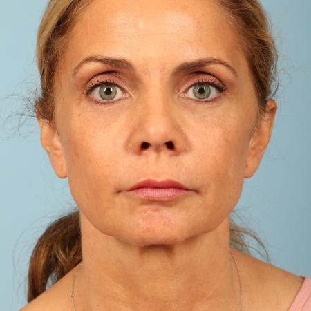 Before image 1 Case #116586 - Facelift, Necklift