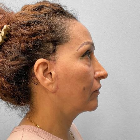 After image 3 Case #116876 - Facelift & Laser Resurfacing