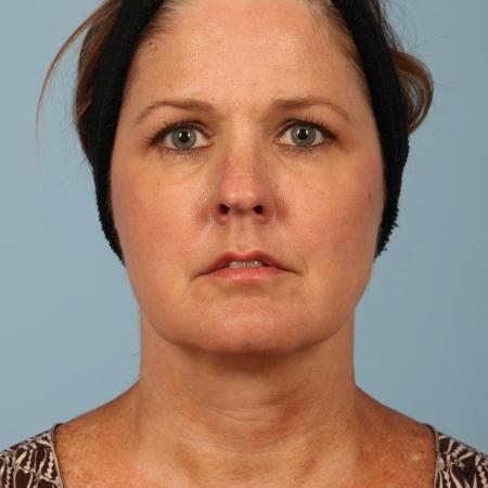 Before image 1 Case #116501 - Facelift and Eyelid Contouring