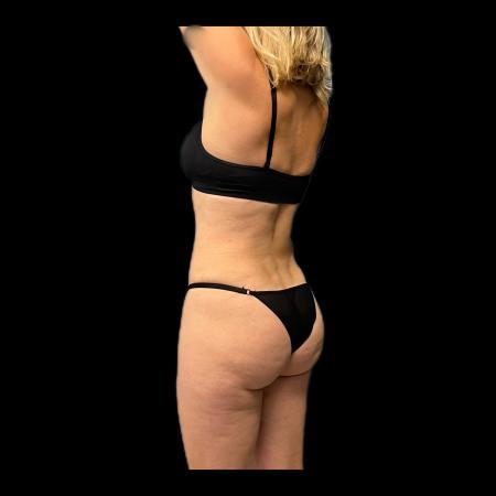 After image 4 Case #116076 - R.A.F.T LipoAbdominoplasty and LipoEsculture 