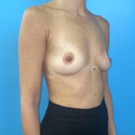 Before image 4 Case #116836 - Breast implants with internal lift