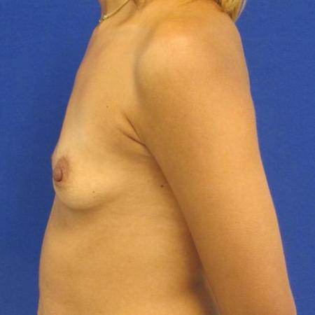 Before image 4 Case #116776 - 30 year-old patient | Breast Augmentation