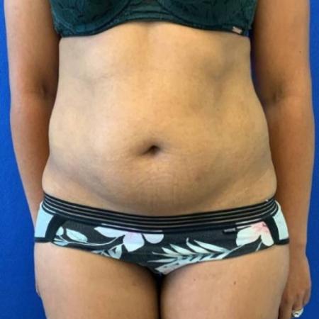 Before image 1 Case #116661 - 38 year-old patient | Liposuction