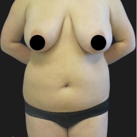 Before image 1 Case #116651 - 23 year-old patient | Liposuction