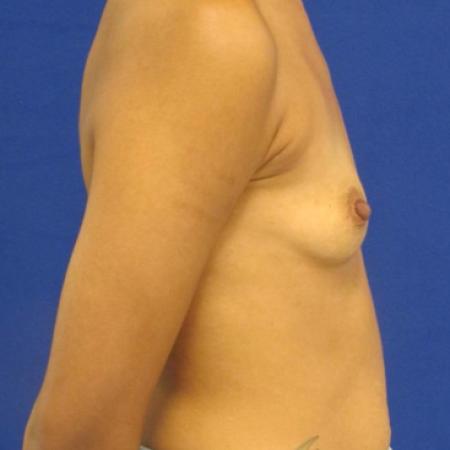 Before image 3 Case #116776 - 30 year-old patient | Breast Augmentation