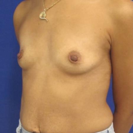 Before image 5 Case #116776 - 30 year-old patient | Breast Augmentation