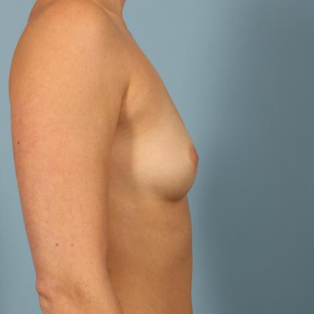 Before image 3 Case #116756 - Breast Augmentation