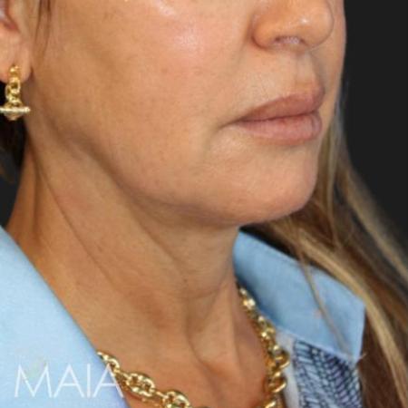 Before image 2 Case #116241 - 55 year old patient | Facial Rejuvenation