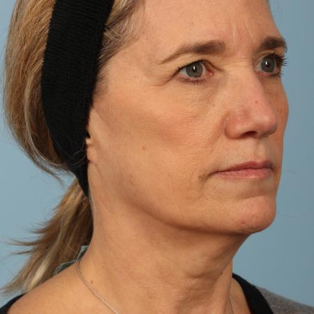 Before image 2 Case #116606 - Facelift with Fat Transfer