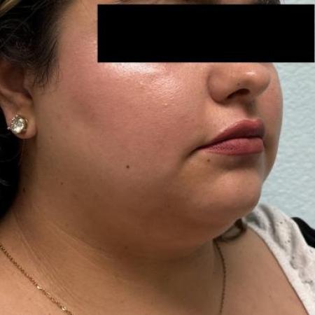 Before image 2 Case #116096 - Submental neck liposuction