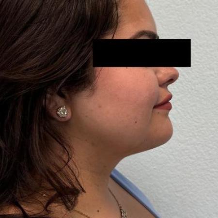 After image 3 Case #116096 - Submental neck liposuction